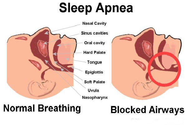 sleep-apnea-difficulty-sleeping