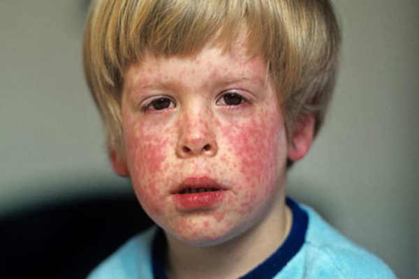 German Measles (Rubella) - Healthline