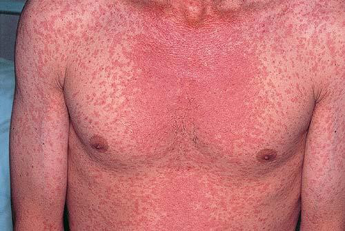 Pictures of Viral Skin Diseases and Problems - Measles