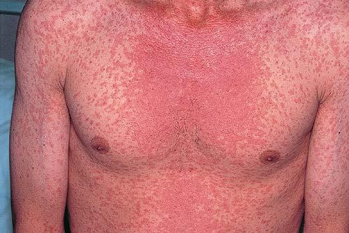 measles Picture Image on MedicineNet.com