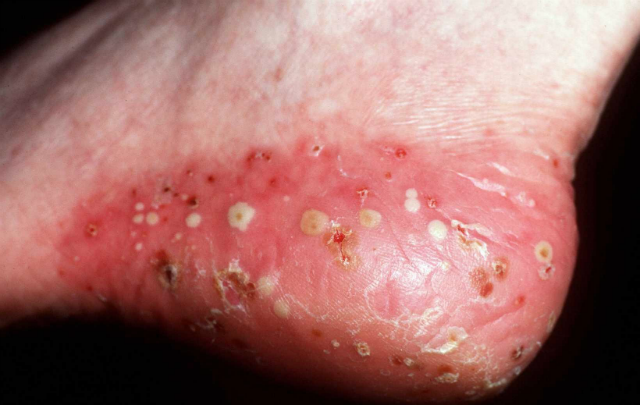 Causes of Hand rash - RightDiagnosis.com
