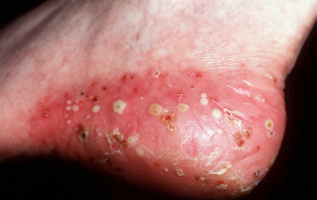 Pustular eczema | Article about pustular eczema by The ...