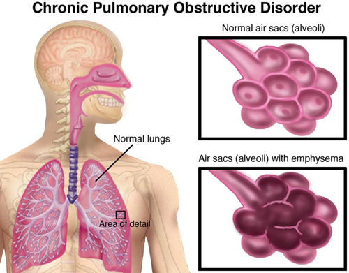 smoking-effects-respiratory-system-damage