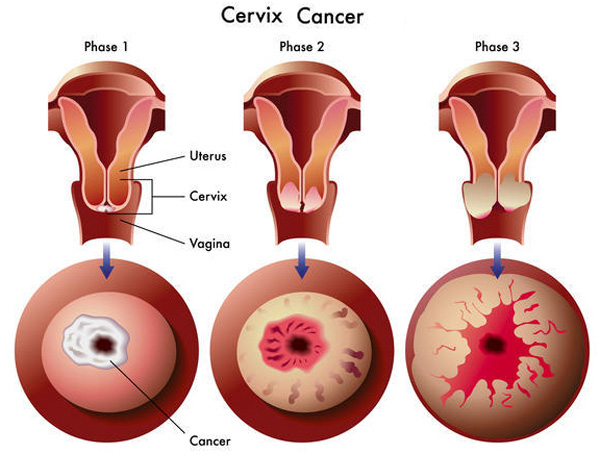 cervix-cancer-medifee