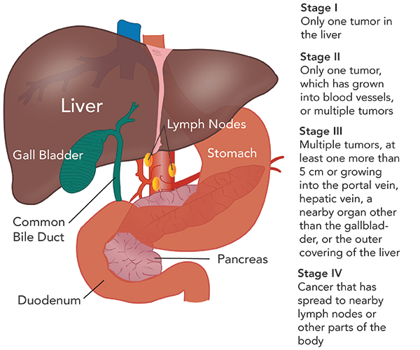 gastric cancer prognosis by stage