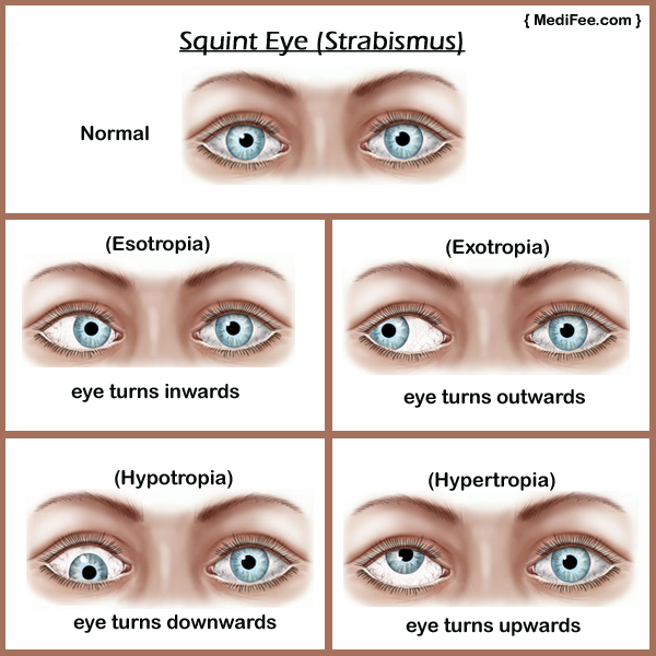 Adult Strabismus 89