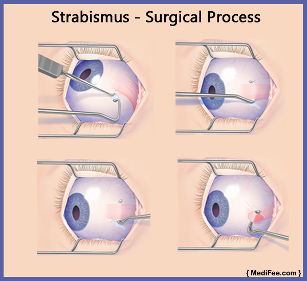 strabismus adults Treatment