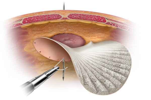 All You Need To Know About Your Hernia Surgery