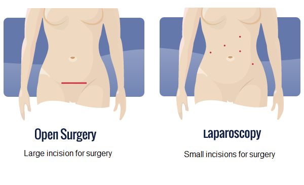 How long is the expected recovery time after hiatal hernia surgery?