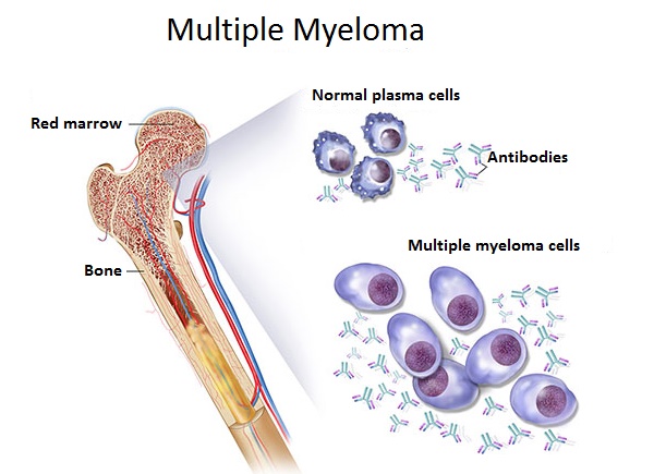 Lymphome uterin leucemie simptome incipiente