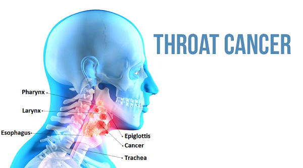 Throat Cancer Causes And Treatments 