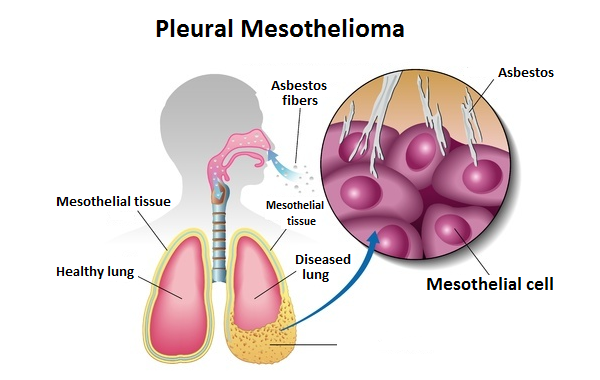 Mesothelioma – A Rarest Form of Cancer Now in India