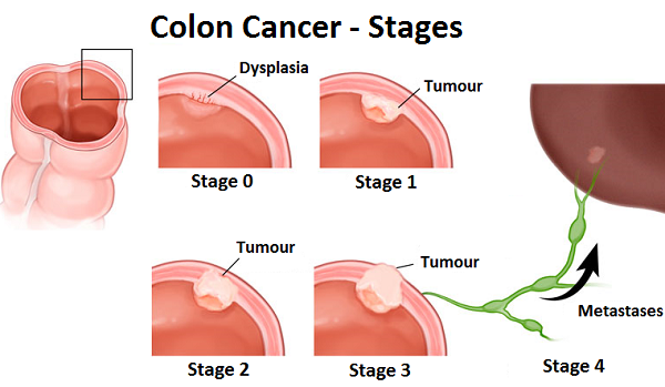 Colon Cancer Causes Diagnosis And Treatment