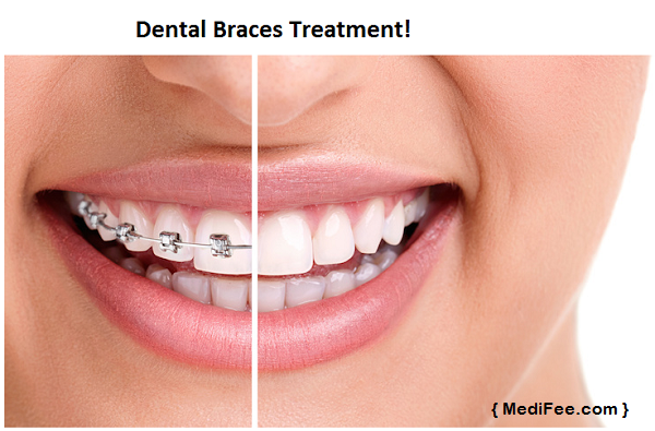 Types Of Dental Braces Medifee Healthcare 