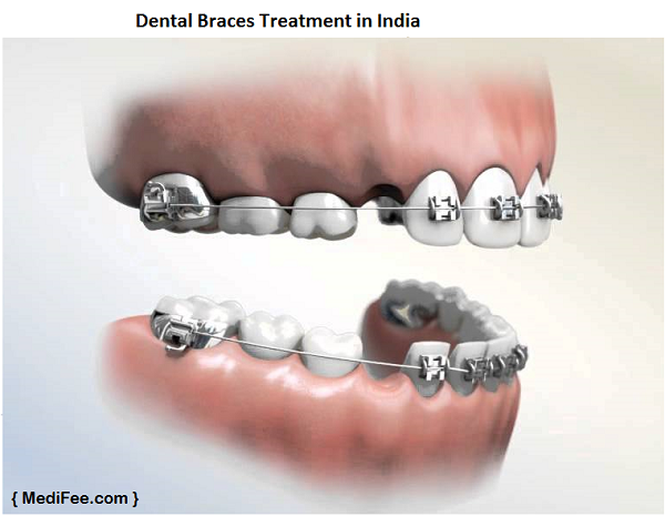 dental braces treatment in India
