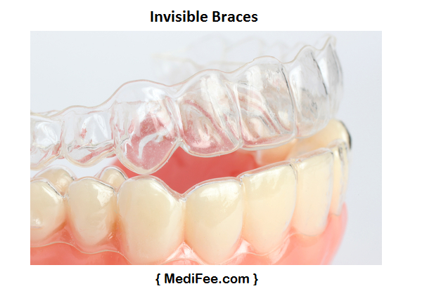 invisalign braces