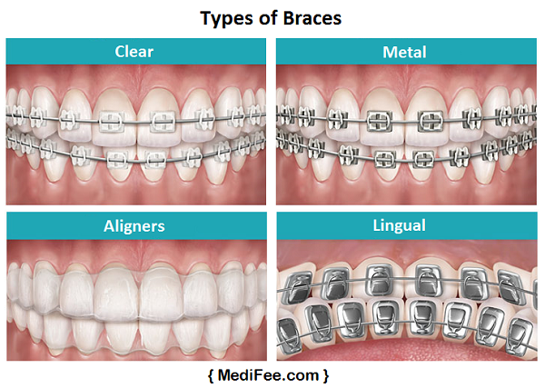 dental braces types