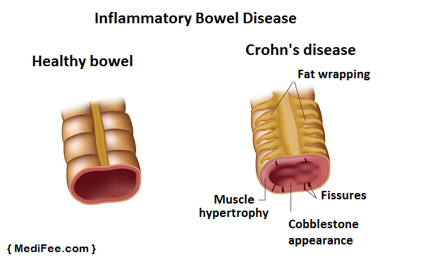 IBD