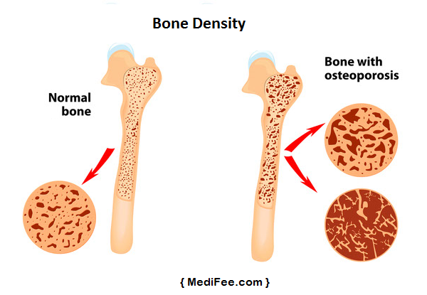 bone-density-images-medifee