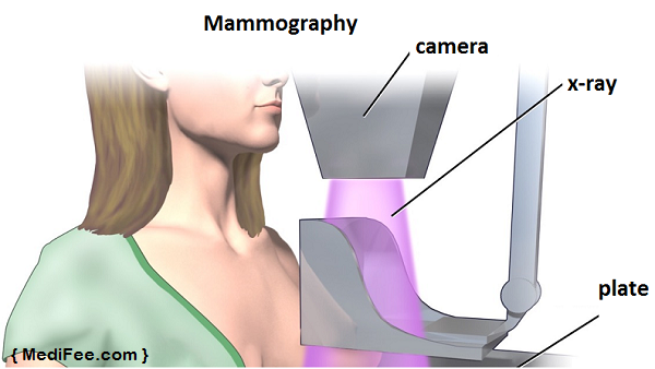 mammogram-image