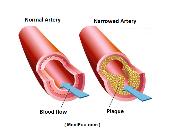 plaque-buildup-artery-cholesterol
