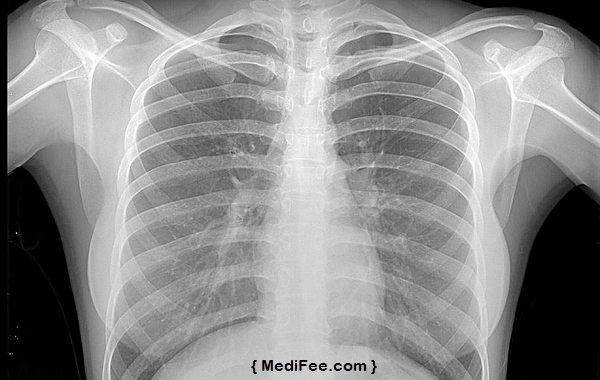 x-ray-of-chest