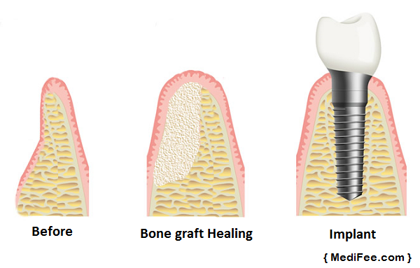 bone-grafting