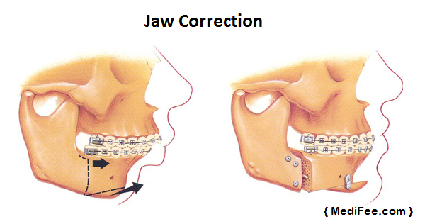 jaw-correction-surgery