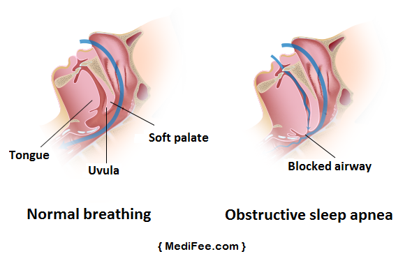 OSA-obstructive-sleep-apnea