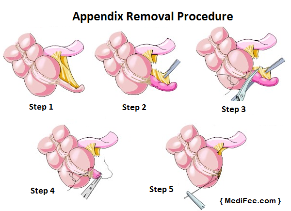 appendix-removal-procedure-appendectomy