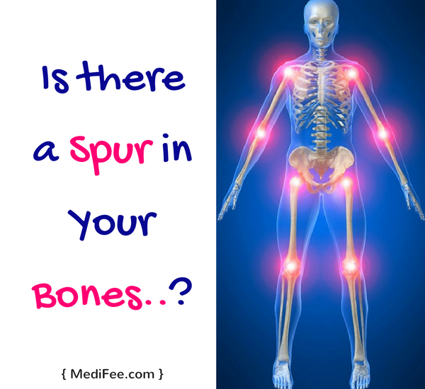 bone-spur