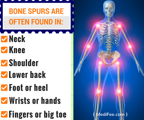 bone-spur-positions
