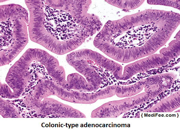 colonic-type-adenocarcinoma