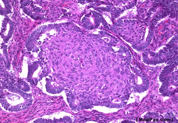 Endometrioid carcinoma