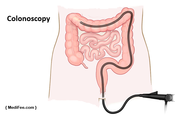 procedure-of-colonoscopy