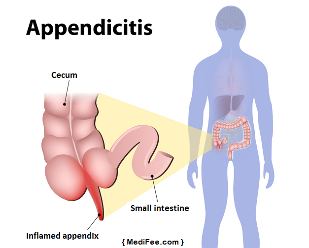 inflamed-appendix