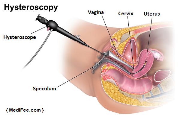 diagnosing-uterine-cancer