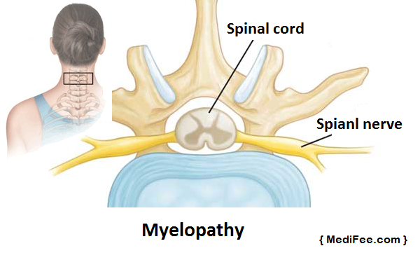 bone-spur-myelopathy