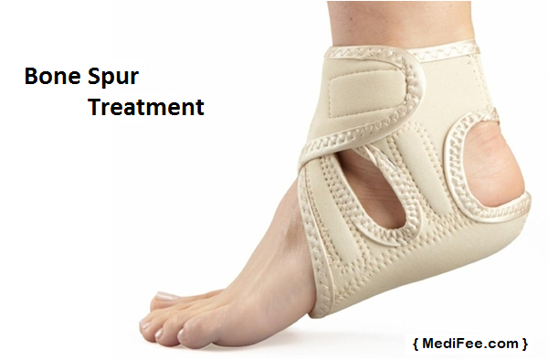 bone-spur-treatment-options