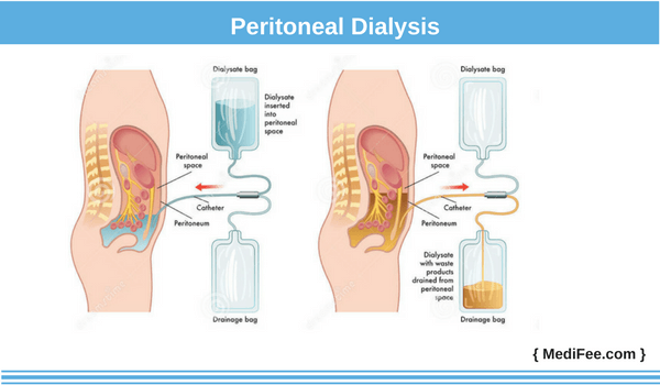 peritoneal method of dialysis