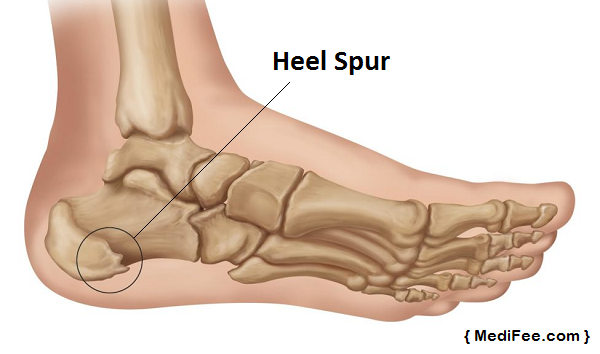 heel-spur-image