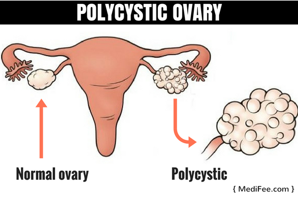 ovary-cysts