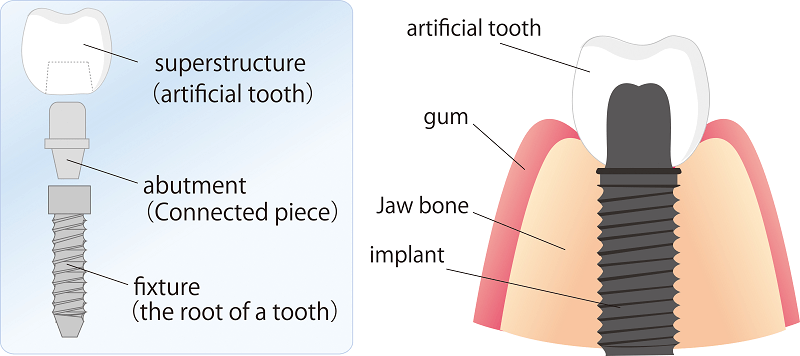 Parts-of-Dental-Implants