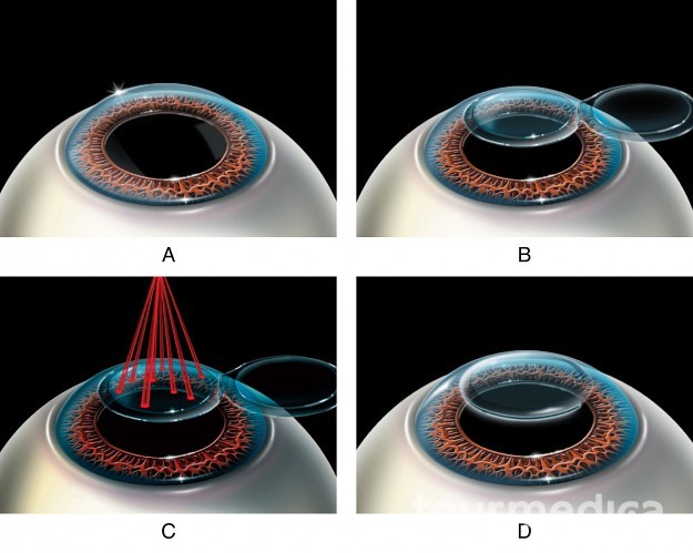 Lasik_Treatment