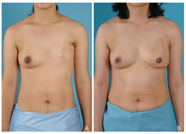 After_breast_disorder