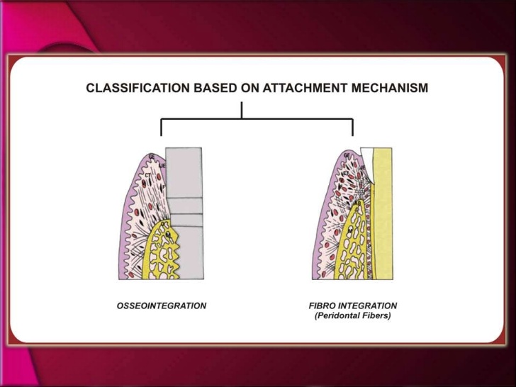 ​ Fibrointegration-Dental-Implants