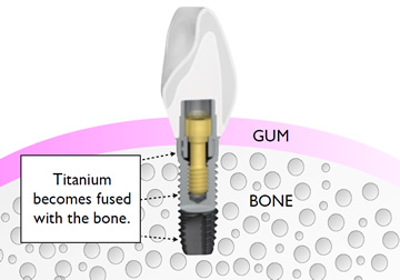 osseointegration-Dental-Implants