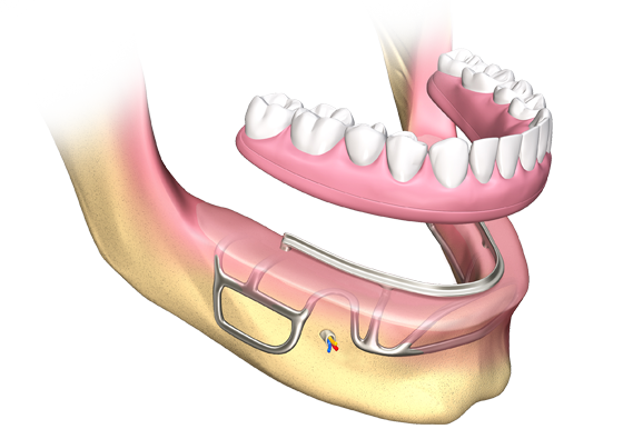 subperiosteal-dental-implants