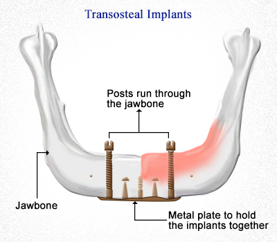 transosteal-dental-implants