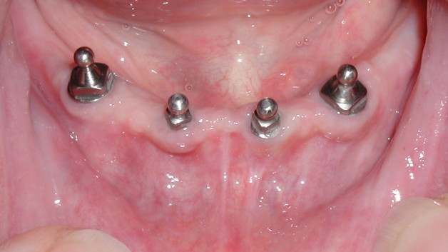 Intramucosal-Dental-Implant